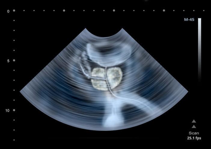 prostatitis M